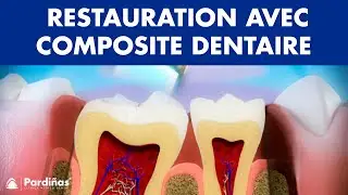Traitement des caries - Restauration avec composite dentaire &copy;