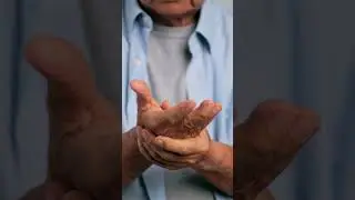 Dried Berries Can Fight Against Inflammation In Arthritis