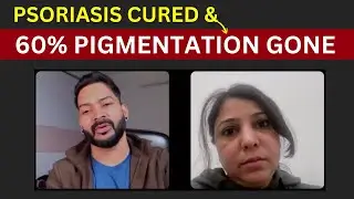 Psoriasis cured & 60% Pigmentation gone with your diet