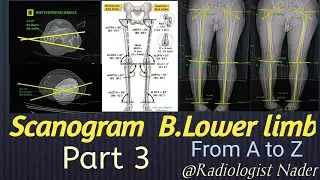 سكانوجرام.الجزء3(المحور التشريحي وزواياه)Scanogram B.lower limb. part 3(Anatomical Axis with Angles)