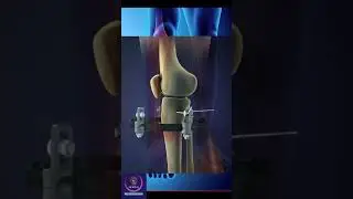 Tibial Fracture and fixation #education #shorts