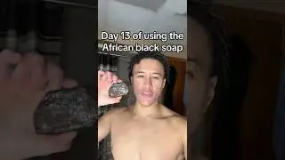 Day 13 of using the african black soap #skincare #acnescars
