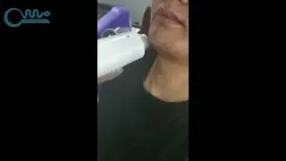 TB1100   M&aacute;y triệt l&ocirc;ng Diode Laser 808nm TB8081