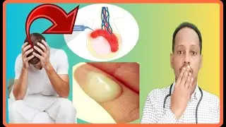 EPIDIDYMITIS  CAABUQA TUBOYINKA SHAHWADA RAGA KU DHACA WAXA KENA CALAMADAHA LAGU GARTO & DAWEYNTISA