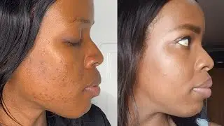 TCA Medium depth peel - Conclusion and Final Results!