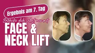 Deutsche Patientin: Deep Plane Facelift & Lidstraffung in der T&uuml;rkei | AKM Clinic