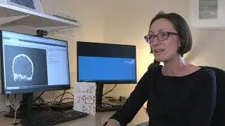 Smoking and Dementia