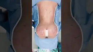 Curves redefined with Liposuction and Safe BBL transformations  #beforeandafter #safebbl