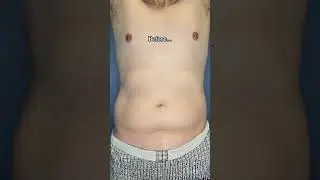 Before & After Body Contouring Results
