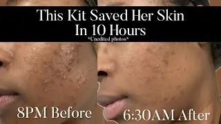 Acne Gone Overnight?! The Skincare Kit That Works FAST! | Dermalogica