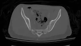 CCH Bladder Rupture