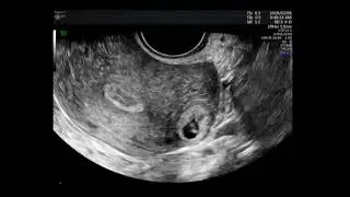Intramural twin pregnancy after in-vitro fertilization