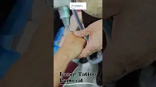 Laser tattoos disappear in just a few minutes. #lasertattooremoval #tattooremovalspecialist