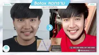 Idoli Review Case : ป็อกวง Zeed Botox ลดกราม