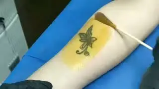 💁🏻&zwj;♀️💥RUIPU-Picosecond+Co2 Fractional Laser for Tattoo Removal Treatment