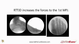 HyProCure is the Solution for Misaligned Feet | Kansas City Direct Care Podiatrist