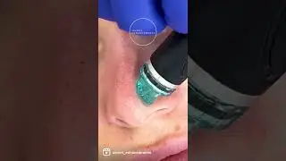 Blackheads Be Gone! - Hydrafacial ASMR 🤤😍