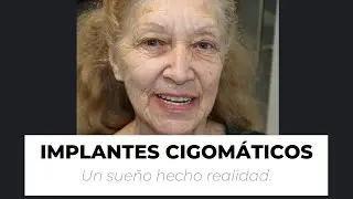 ✅  Implantes dentales sin hueso. Ventajas de los cigom&aacute;ticos.