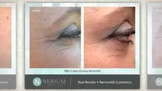 Nerium Before and After Wrinkle Reduction | Non Surgical Wrinkle Reducer NeriumAD