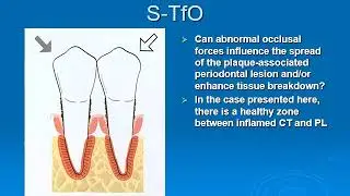Trauma From Occlusion