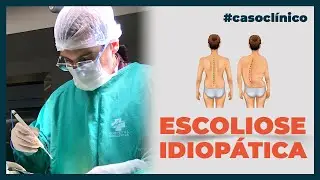ESCOLIOSE IDIOPÁTICA – CASO CLÍNICO | Dr. Dante Giubilei
