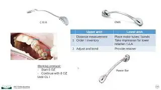 A hybrid multi segmental approach to address Class II & Class III Correction