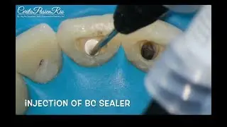 continuous wave bioceramic bc sealer ceraseal EQV obturation metabiomed endodontic anterior tooth