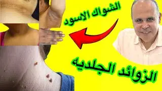 علامات خطيره في الجلد لمقاومه الانسولين  والسرطان..الشواك الاسود والزوائد الجلديه