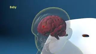 What is Subdural Hematoma? Causes, Symptoms, and Treatments