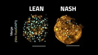 Human 3D in vitro NASH model for efficacy testing of clinical drug candidates | InSphero