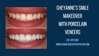 Cheyanne's Smile Transformation With Porcelain Veneers