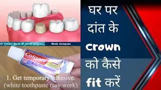 How to fix tooth crown at home in case of emergency-Dr.Praveen Bhatia