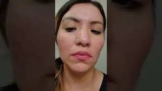 #biooil #acne #scars          first week with using biooil.