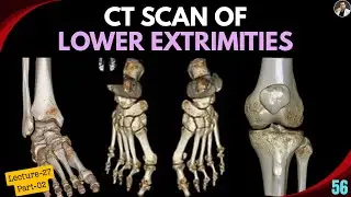CT Scan of Lower Extremities Techniques | Tutorial-56 | CT Ankle and Foot | CT Knee Joint | Filming