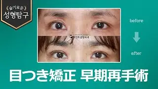 【韓国二重整形】過度な目つき矯正の早期再手術、まぶたの凹み