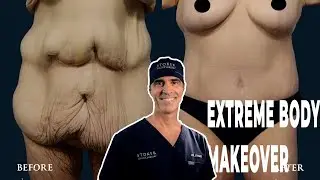 UPPER AND LOWER BODY LIFT | DR. DAVID STOKER | LOS ANGELES