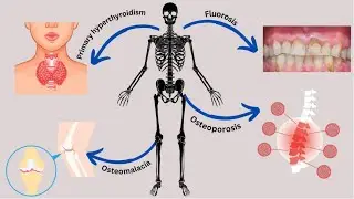 List, Examples, Types of Metabolic Bone Disease