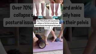 Here&rsquo;s the truth Over 70% of children diagnosed with valgus foot or &ldquo;fallen arches&rdquo;