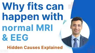 Why Fits Can Happen with Normal MRI & EEG | Hidden Causes Explained