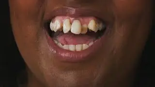 Help &ndash; My Teeth Are Stopping Me from Living!