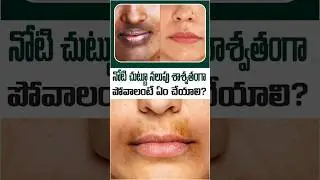 How to Remove Dark Pigmentation Around the Mouth Permanently | Dr Anand Hair & Skin