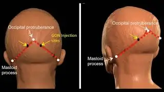 Video New drug uses antibodies to stop chronic migraines, without side effects