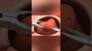 Appendix Surgery Explained in 3D