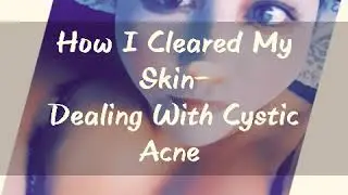 Dealing with Cystic Acne and How Sunday Riley Helped  Clear It