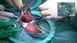 virgin penoscrotal inflatable penile implant KVR 14022018 Lisboa final version incl patient data 108