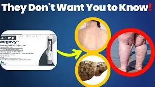 🚨 Wegovy Side Effects & Safety &ndash; What You NEED to Know! ⚠️💉