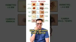 Diferencias entre un lunar y un melanoma (c&aacute;ncer de piel). #medicina #shorts