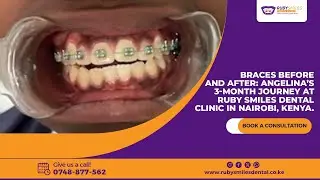 Angelina braces journey before and after