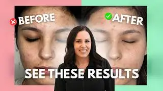How to Clear Acne Scars