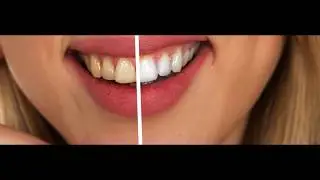 Dentist Surrey BC CALL NOW (604)-670-2655  | Emergency Dental Services In Surrey
